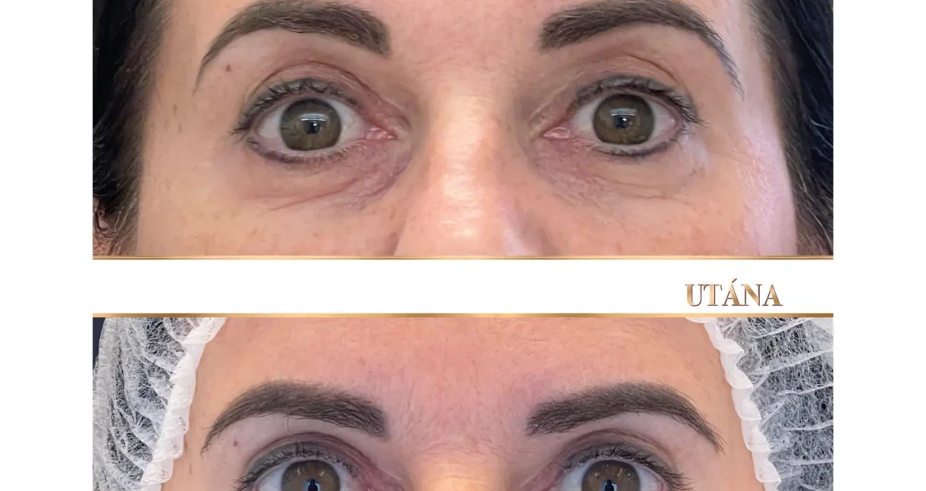 felső szemhéj duzzanat