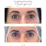 felső szemhéj duzzanat