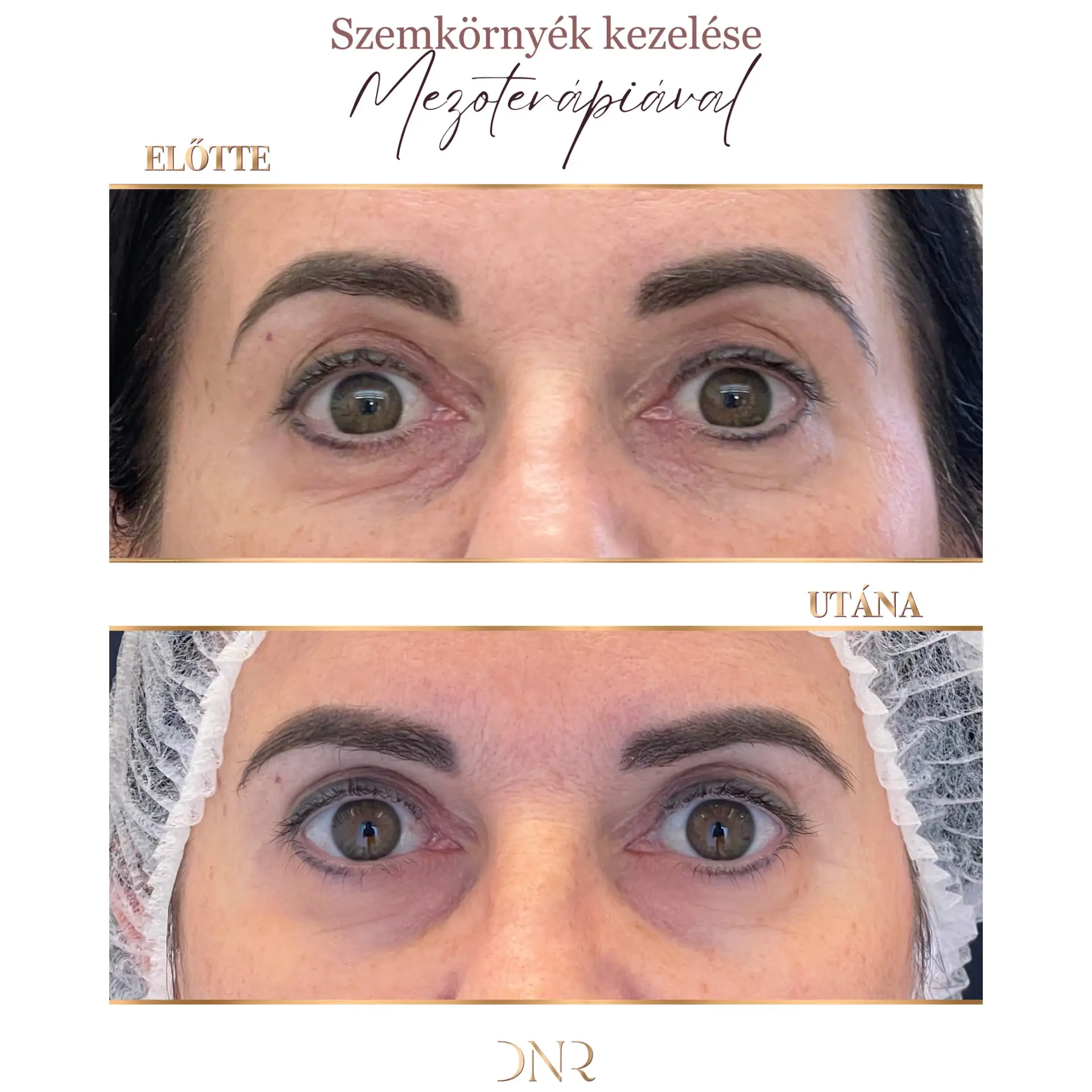 felső szemhéj duzzanat