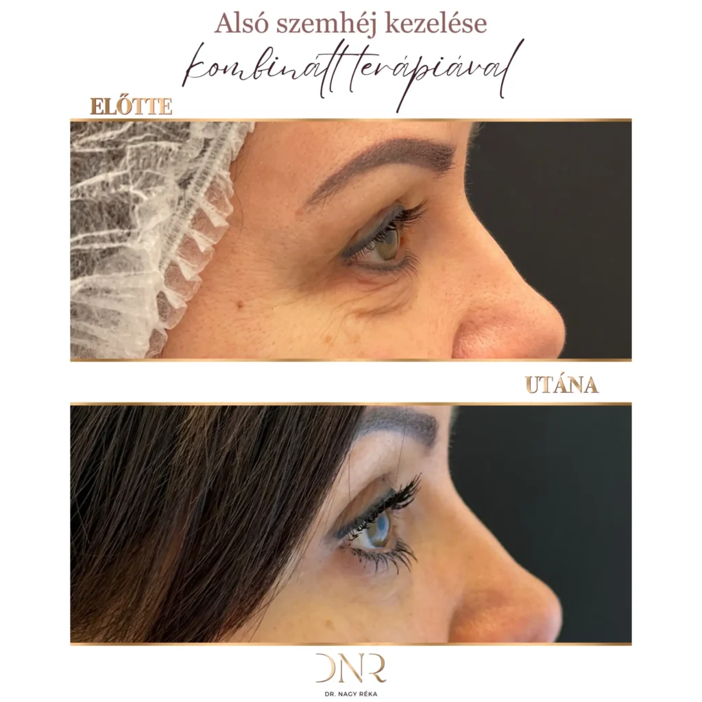 szem alatti sötét karikák