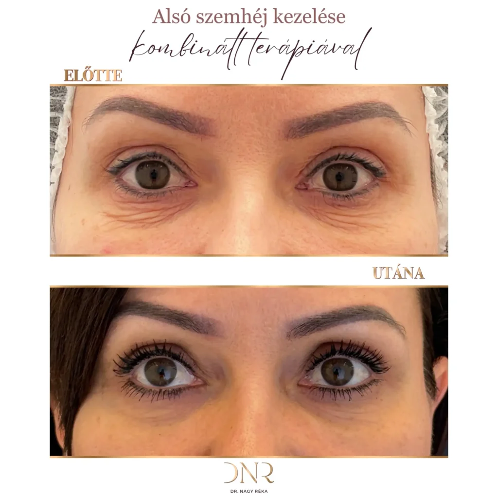 szem alatti sötét karikák