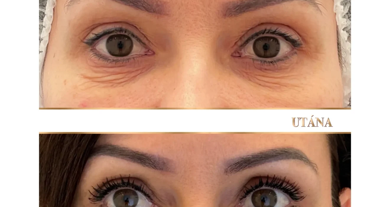 szem alatti sötét karikák