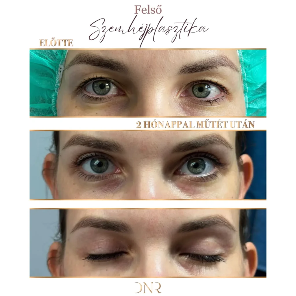 szemhéjplasztika kecskemét