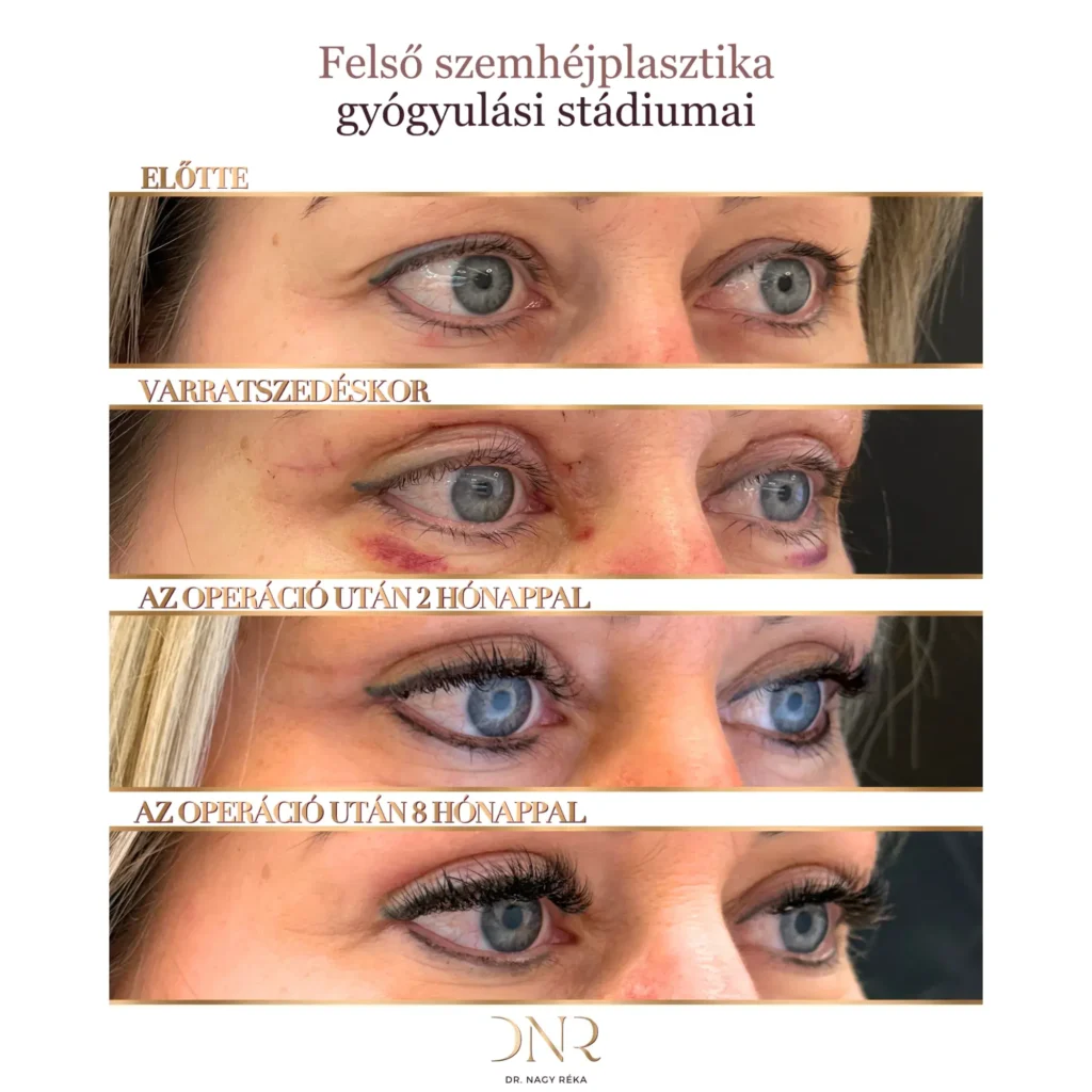 szemhéjplasztika képek
